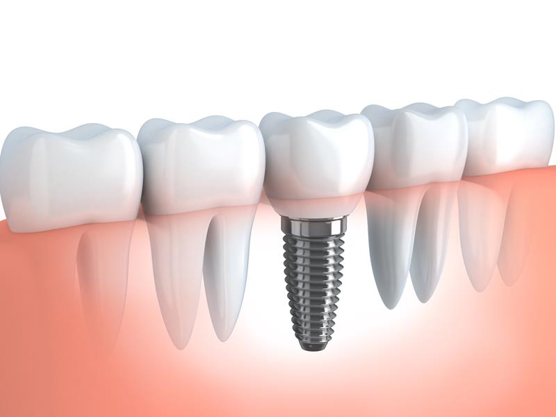 Dental Implants  Savage, MN 